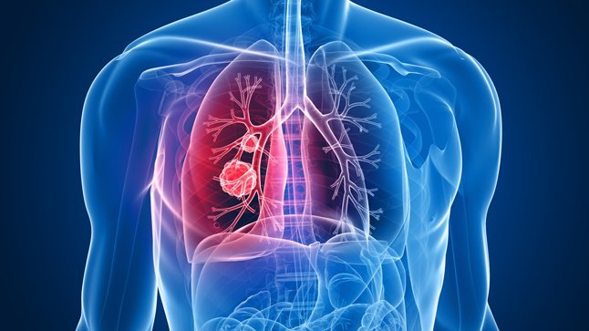 cancer pulmon