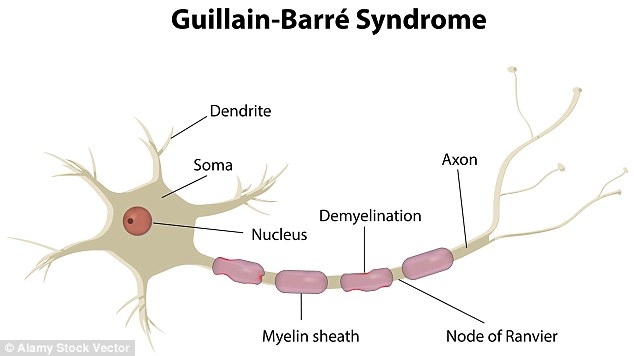 sindrome-guillian.jpg