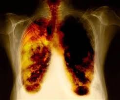 cancer_pulmon.jpg