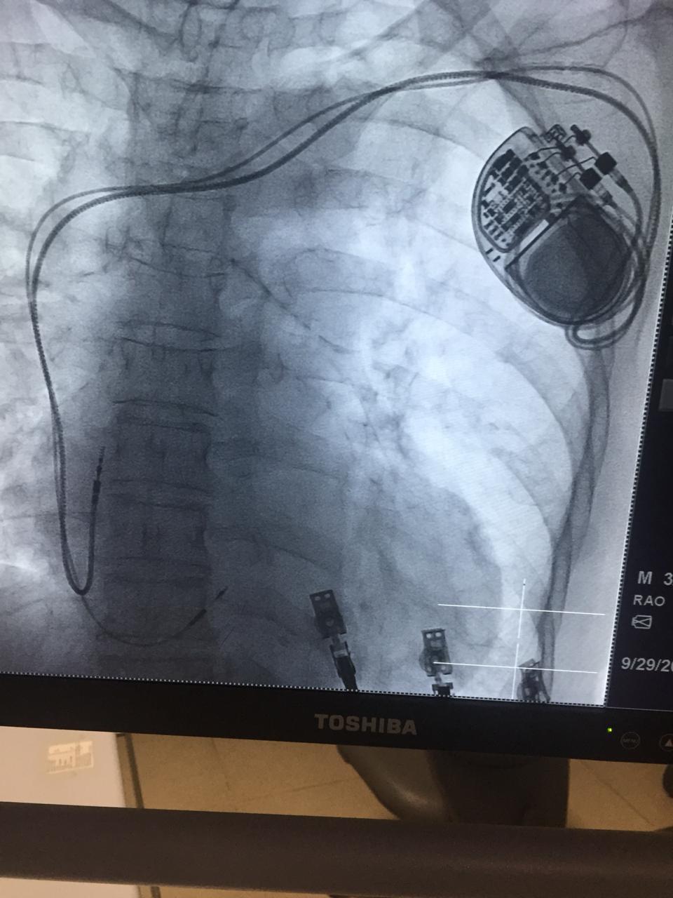 Centro_Cardiovascular_HOMS_coloca_primer_implante_con_estimulación_en_el_has_de_His_en_la_región_del_Cibao.1.jpeg