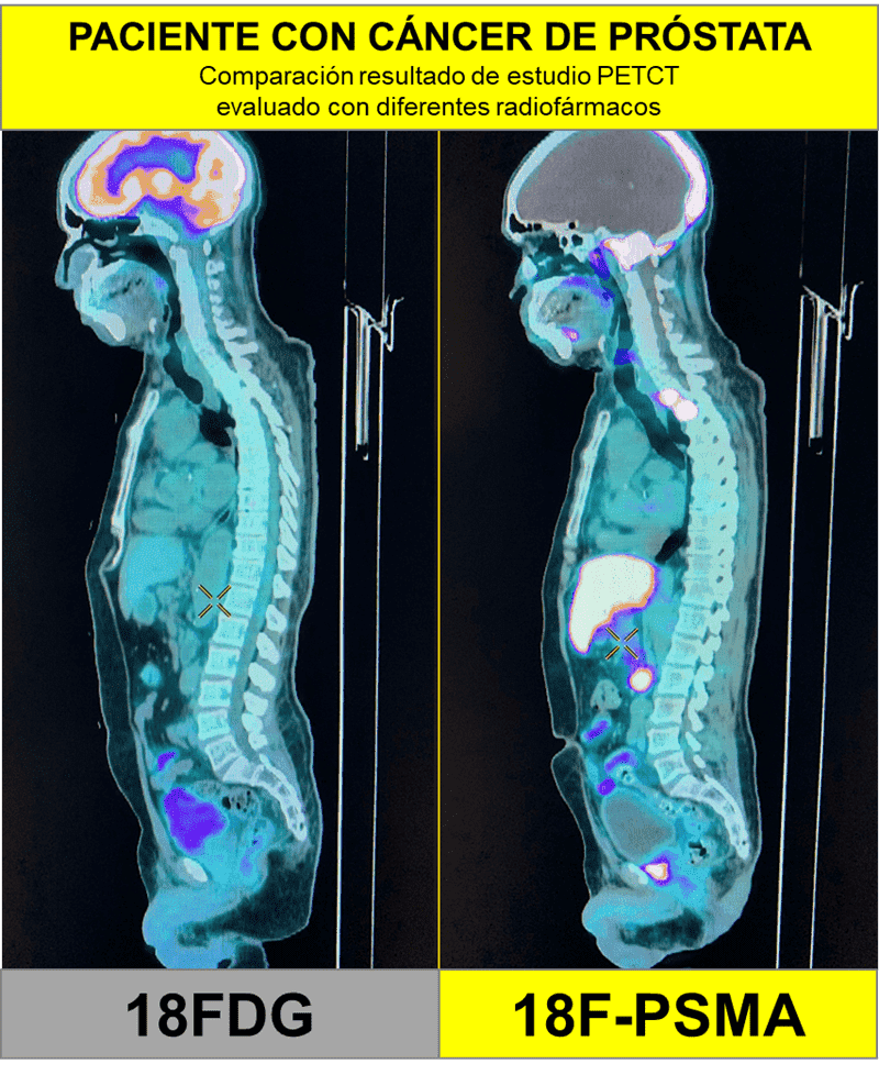 psma_vs_FDG_imagen.png