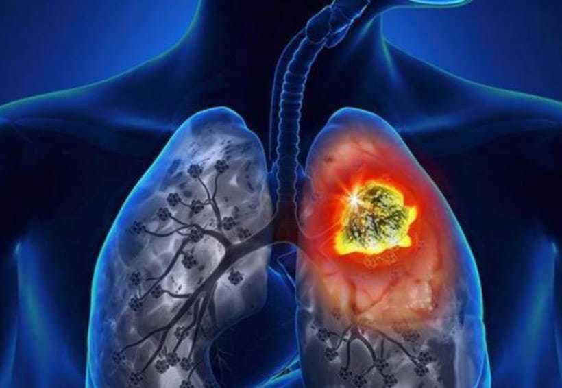 cancer-pulmon-768x407-1.jpg