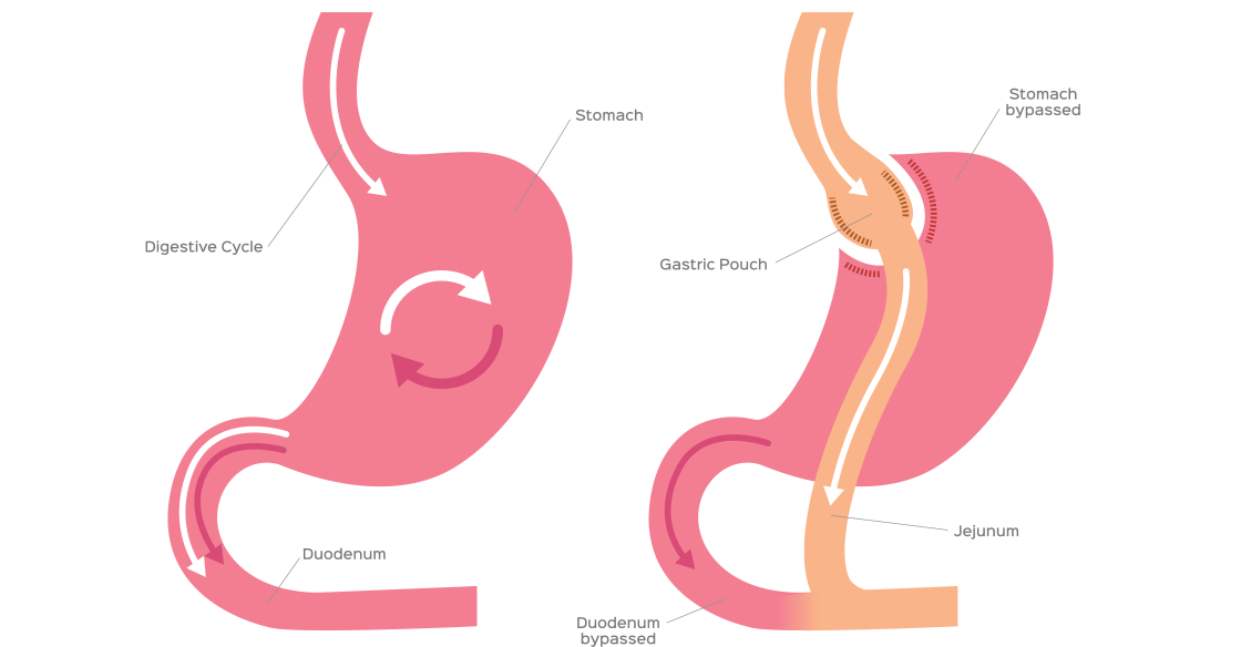 patient-perspective-gastric-bypass-surgery.png
