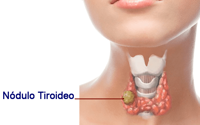 nodulos_tiroideos.png