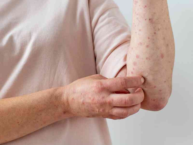 skin-allergy-on-person-s-arm.jpg