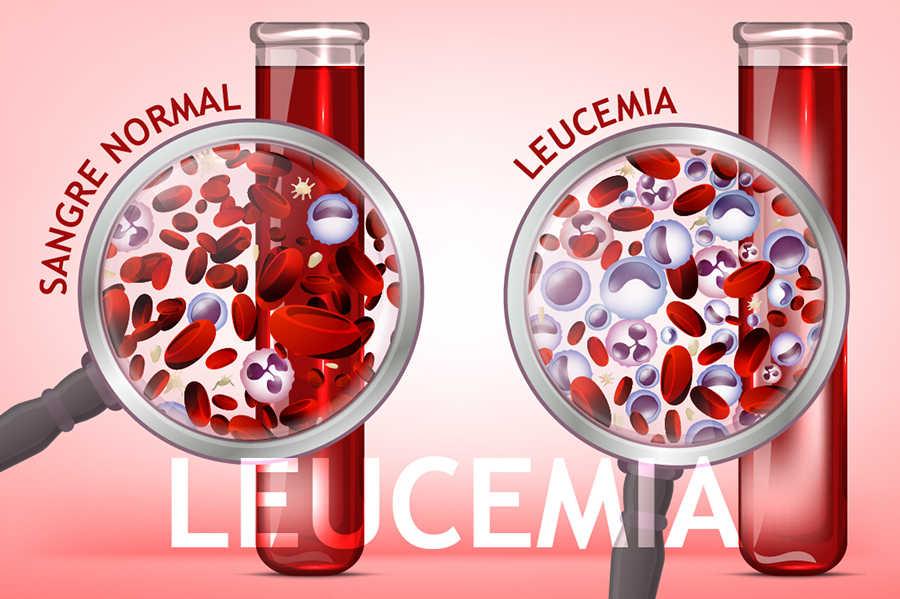 La-Leucemia.jpg