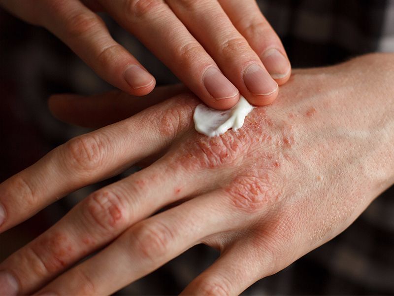eczema-skin-itching.jpg