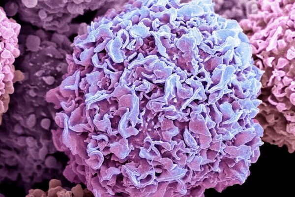 Desarrollan una IA capaz de diferenciar las células cancerosas de las normales