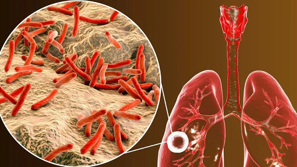 CMD preocupado por aumentos de tuberculosis en el país (VIDEO)