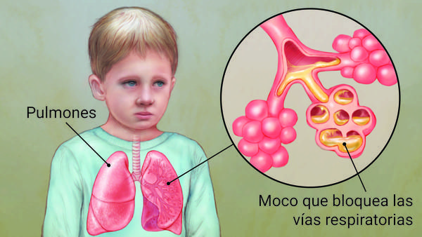 Fibrosis quística otra enfermedad cuyos efectos devastadores se pueden evitar contamizaje neonatal