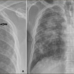 Persistencia y cambios en las enfermedades pulmonares ocupacionales