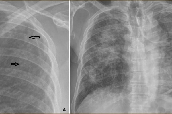 Persistencia y cambios en las enfermedades pulmonares ocupacionales