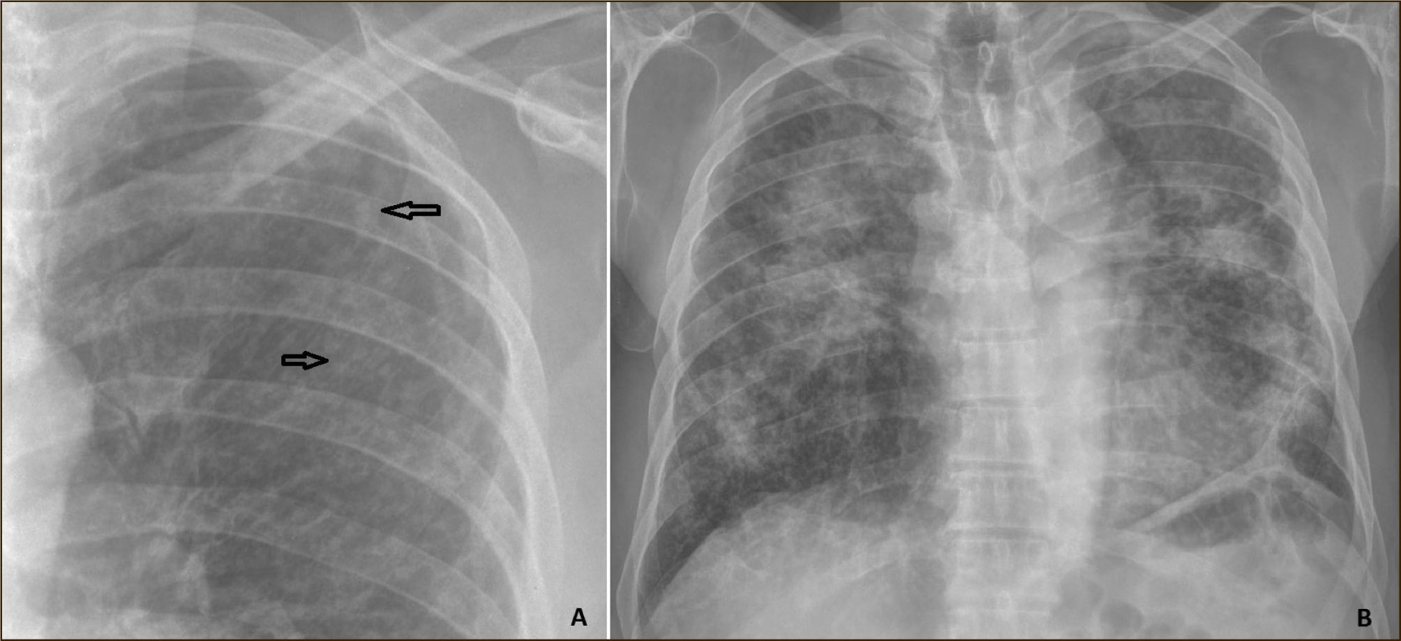 Persistencia y cambios en las enfermedades pulmonares ocupacionales